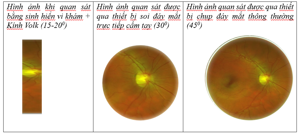 Công nghệ chụp đáy mắt giúp chẩn đoán bệnh võng mạc- Ảnh 3.