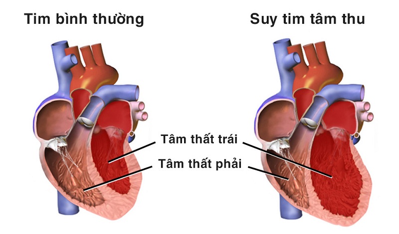 Điều chỉnh lối sống như thế nào để điều trị hiệu quả bệnh suy tim?- Ảnh 2.