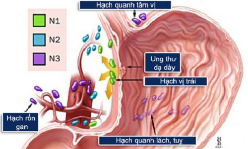 Những tiến bộ mới trong chẩn đoán và điều trị hạch di căn trong ung thư dạ dày- Ảnh 1.