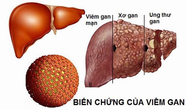 Viêm gan B có lây không?- Ảnh 1.