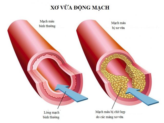 8 cách giúp phòng xơ vữa động mạch, ngăn ngừa đột quỵ- Ảnh 1.