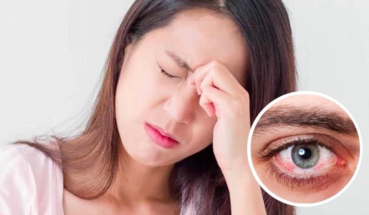 3 biểu hiện của viêm kết mạc mùa xuân- Ảnh 2.