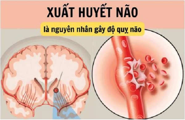 Xuất huyết não có tái phát không?- Ảnh 1.