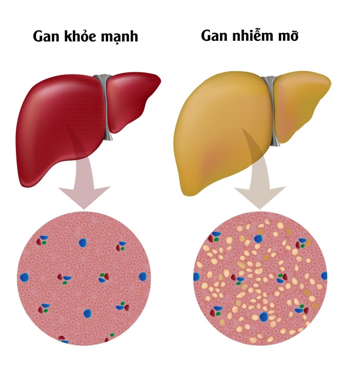 Gan nhiễm mỡ không do rượu là gì, ai dễ mắc?- Ảnh 2.