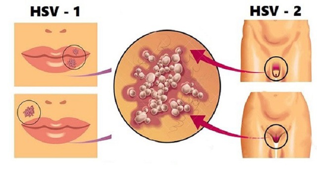 5 điều nên biết khi bị mụn rộp sinh dục- Ảnh 1.