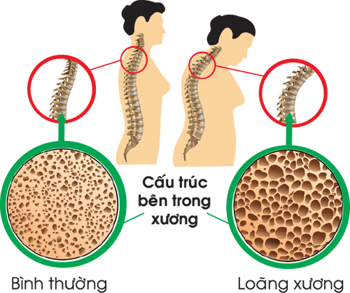 Uống rượu ảnh hưởng đến xương như thế nào?- Ảnh 2.