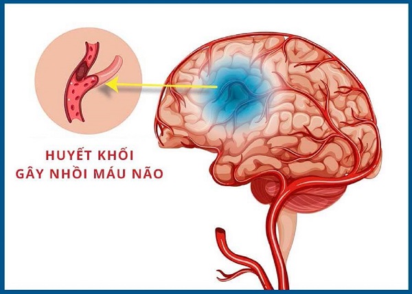 Ai có nguy cơ đột quỵ nhồi máu não?- Ảnh 1.