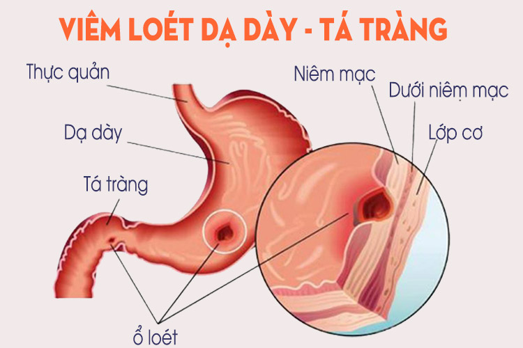 Nguyên nhân và triệu chứng của bệnh viêm dạ dày - Trung Tâm Y Khoa Pasteur  Đà Lạt