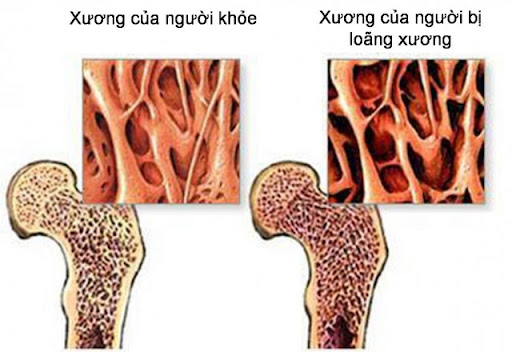 Loãng xương - Cần phòng ngừa ngay từ khi còn trẻ | Trung tâm Kiểm soát bệnh  tật Hà Tĩnh