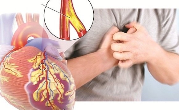Các bài thuốc từ củ kiệu- Ảnh 2. Nhận biết cơn đau tức ngực của bệnh mạch vành