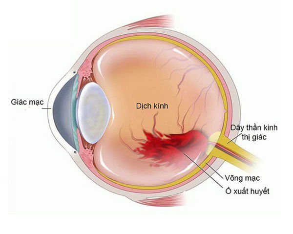 Xuất huyết dịch kính có đáng lo ngại?- Ảnh 3.