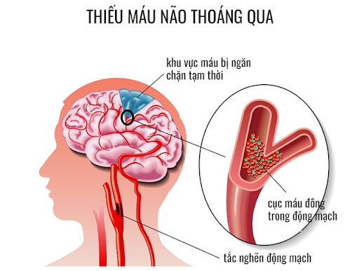 Thiếu máu não thoáng qua làm sao phân biệt với bệnh lý khác?- Ảnh 1.