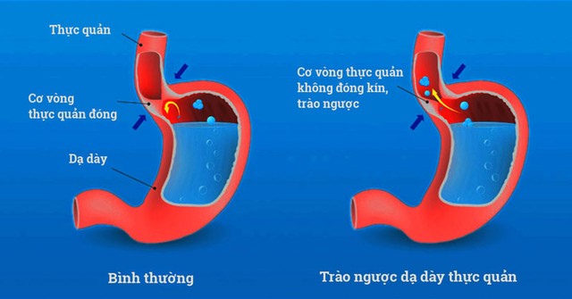 Bệnh trào ngược dạ dày thực quản (TNDDTQ) là tình trạng các chất từ dạ dày có thể là đồ ăn hay dịch acid trào ngược lên thực quản theo một quá trình tự nhiên.