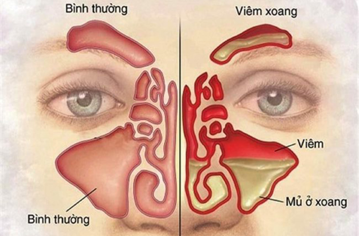 Viêm xoang có gây đau hốc mắt?- Ảnh 2. Viêm xoang có gây đau hốc mắt?- Ảnh 2.