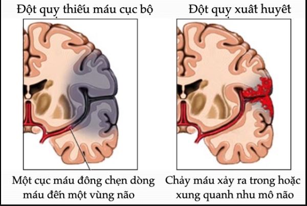 Xuất huyết não nguy hiểm như thế nào?- Ảnh 2.