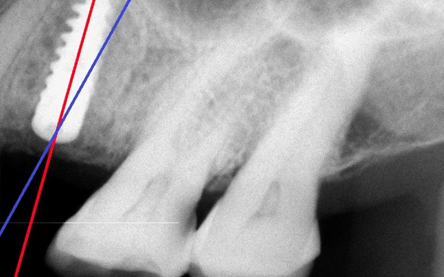 Máng định vị 3D Guide – Giảm nguy cơ biến chứng sau cấy ghép implant- Ảnh 1.