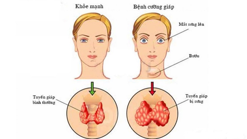 Biến chứng nguy hiểm của bệnh cường giáp- Ảnh 2.