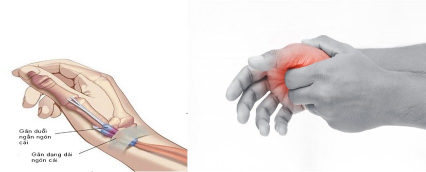 Đau cổ tay lan ra ngón cái là bệnh gì?- Ảnh 1.