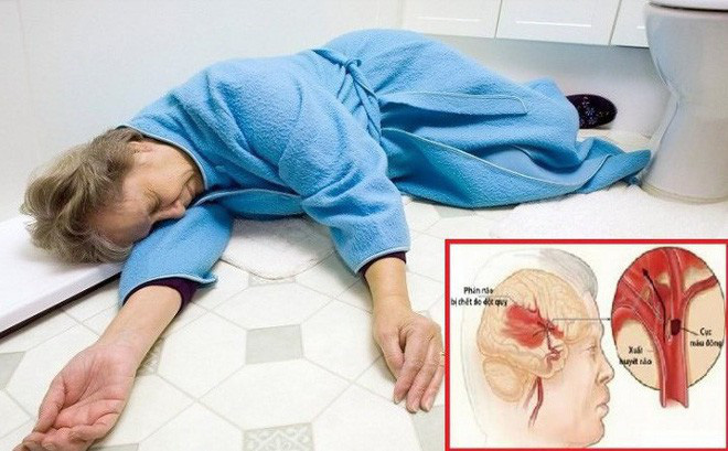 Đột quỵ ở người già có bệnh lý nền cần phát hiện sớm và phòng ngừa- Ảnh 2. Đột quỵ ở người già có bệnh lý nền cần phát hiện sớm và phòng ngừa- Ảnh 2.