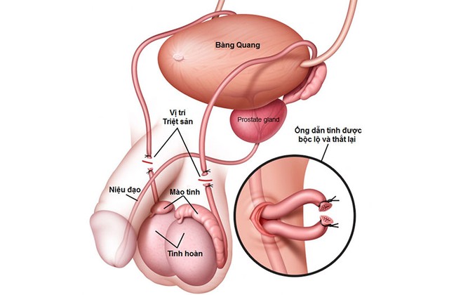 Thắt ống dẫn tinh có làm giảm ham muốn tình dục không?- Ảnh 1.