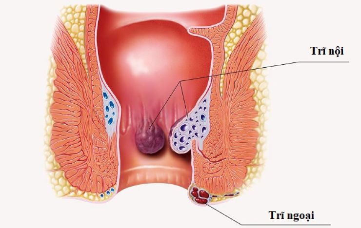 Vì sao bệnh trĩ tái phát, cần làm gì để phòng bệnh?- Ảnh 1.