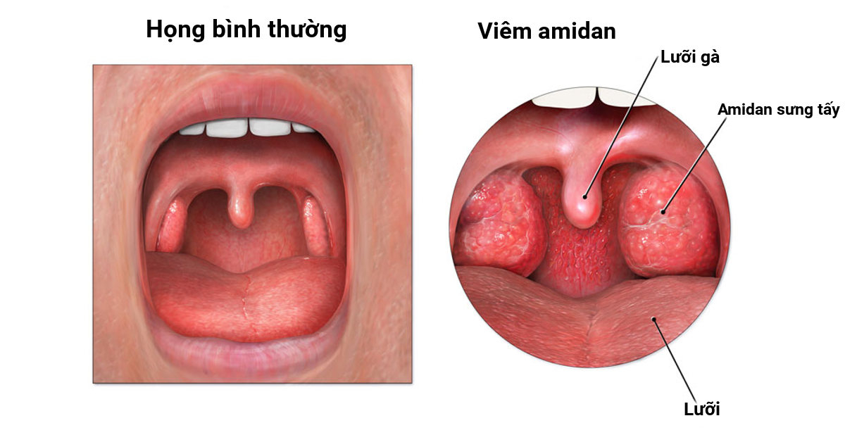 Xuyên tâm liên kháng sinh tự nhiên chữa bệnh đường hô hấp- Ảnh 2.