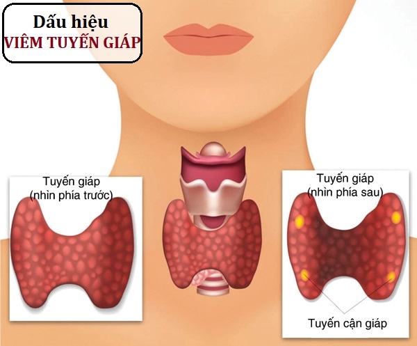 Nguyên nhân gây viêm tuyến giáp Hashimoto- Ảnh 1.