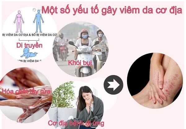 Điều trị viêm da cơ địa ai cũng cần biết- Ảnh 1.