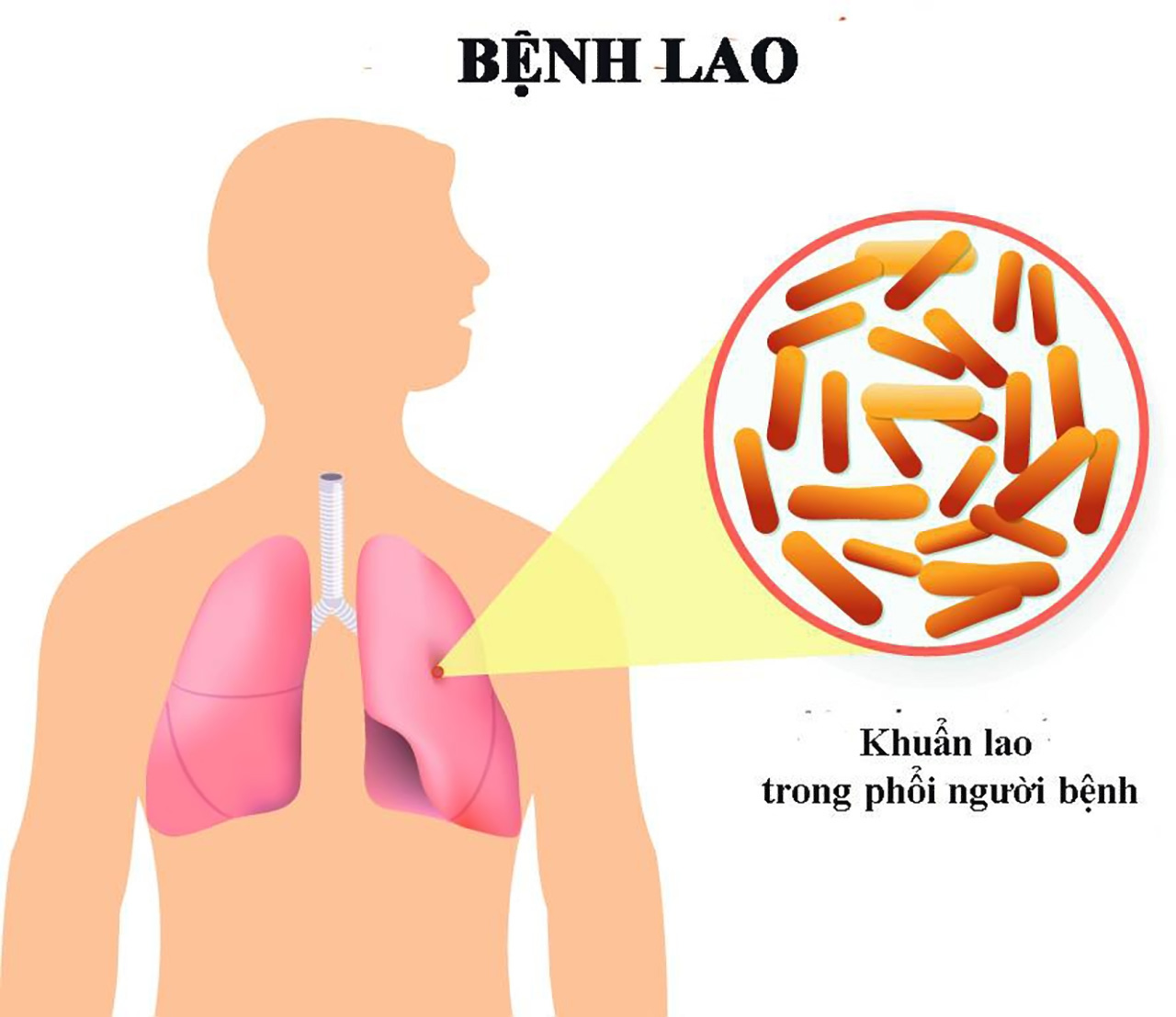 WHO kêu gọi đầu tư tăng quy mô sàng lọc và điều trị phòng ngừa bệnh lao- Ảnh 1.