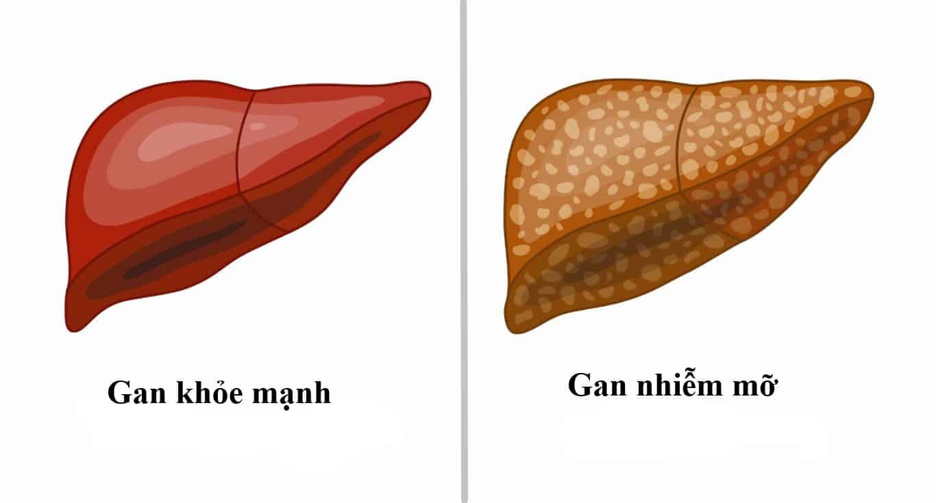 Gan nhiễm mỡ: Nguyên nhân, biểu hiện, điều trị và phòng bệnh- Ảnh 1.