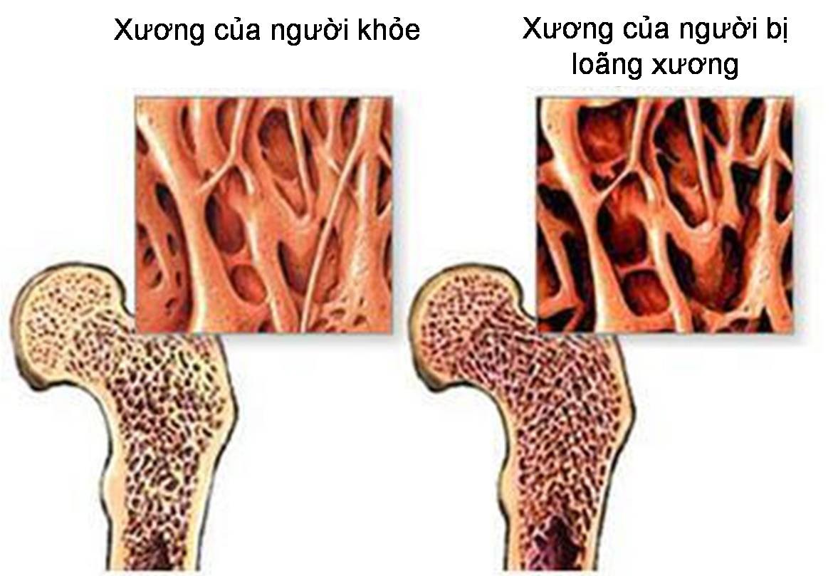 Xoa bóp bấm huyệt có lợi ích gì với người loãng xương?- Ảnh 1.