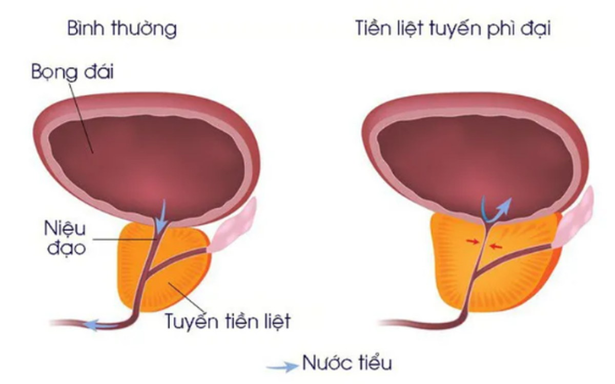 Phì đại tiền liệt tuyến: Nguyên nhân, triệu chứng, điều trị và cách phòng ngừa- Ảnh 1.