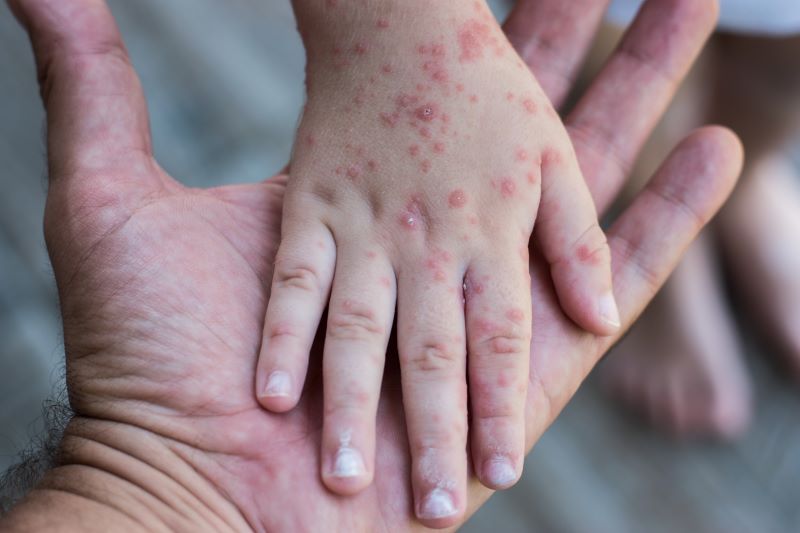 Bắc Kạn mới ghi nhận 1 trường hợp mắc rubella, ai có nguy cơ mắc phải căn bệnh này?- Ảnh 2. Bắc Kạn mới ghi nhận 1 trường hợp mắc rubella, ai có nguy cơ mắc phải căn bệnh này?- Ảnh 2.