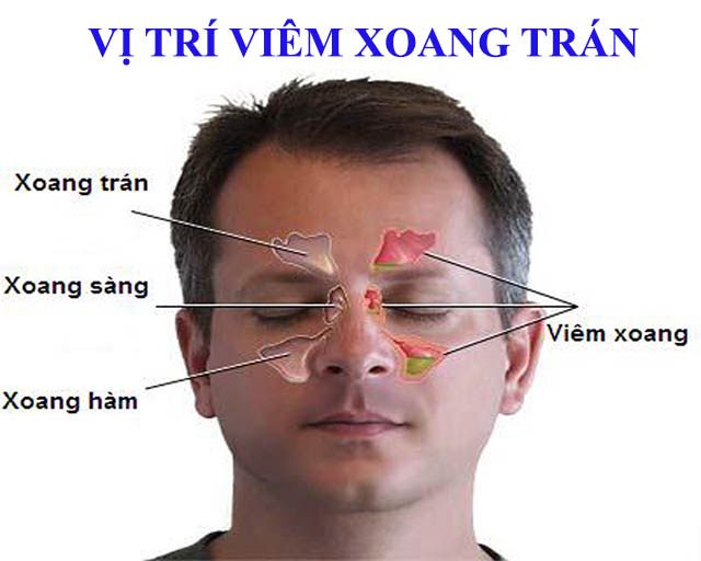 Đau nhức quanh mắt, trán thận trọng với viêm xoang trán- Ảnh 1.