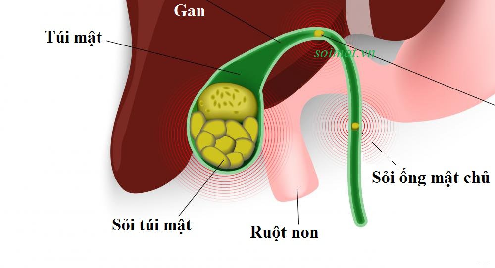 Những yếu tố làm tăng nguy cơ mắc sỏi túi mật- Ảnh 2.