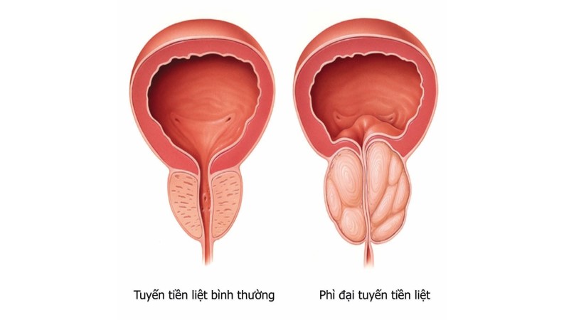 Những biến chứng nguy hiểm của tăng sinh lành tính tiền liệt tuyến- Ảnh 1.