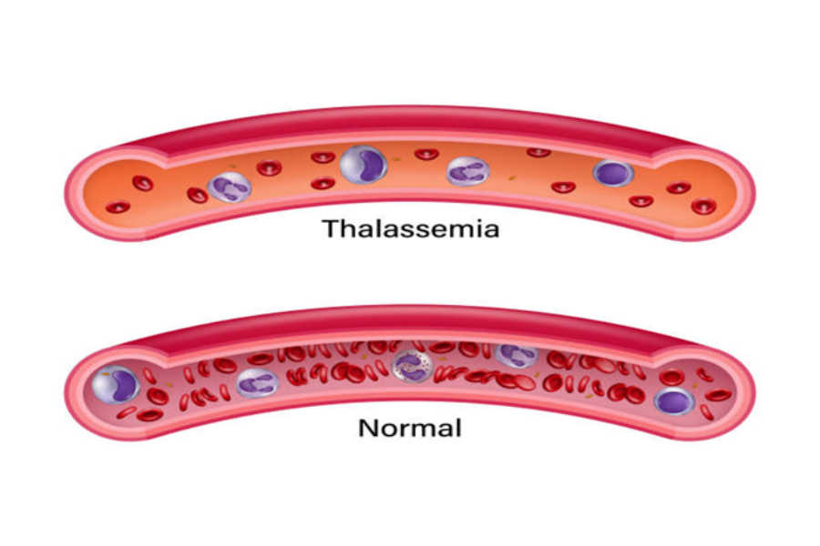 Câu hỏi thường gặp về bệnh Thalassemia (tan máu bẩm sinh)- Ảnh 1.