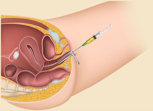 Sự khác biệt giữa thụ tinh trong tử cung và thụ tinh trong ống nghiệm- Ảnh 1.