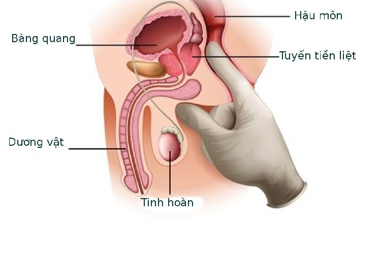 Người cao tuổi mắc u xơ tuyến tiền liệt có cần phẫu thuật?- Ảnh 1.