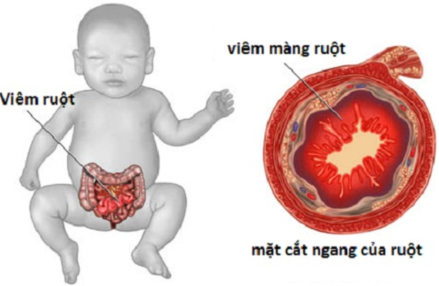 Viêm ruột hoại tử là một bệnh đường ruột cấp tính, dễ gặp trong những bệnh tiêu hóa của trẻ. Ảnh minh họa