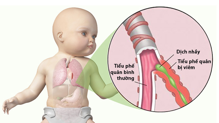 Trẻ viêm tiểu phế quản có nên dùng thuốc kháng sinh?- Ảnh 1.