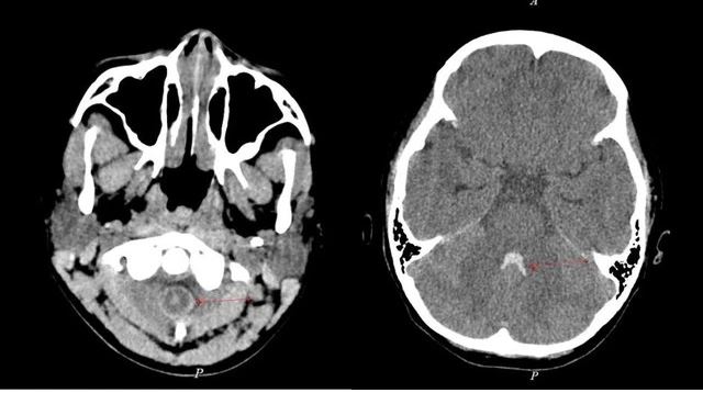 Trẻ 10 tuổi bị xuất huyết não, làm gì để phát hiện sớm căn bệnh này?- Ảnh 1.
