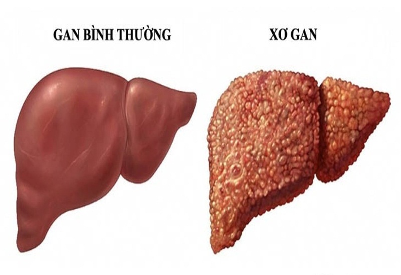 Xơ gan gây xuất huyết tiêu hóa có triệu chứng gì?- Ảnh 2.