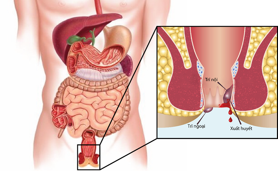 Bệnh trĩ tuy có ảnh hưởng tới cuộc sống nhưng không nặng nề nên bệnh nhân thường bỏ qua.