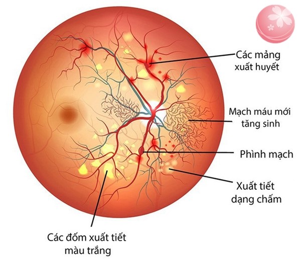 Cách bảo vệ thị lực cho bệnh nhân đái tháo đường- Ảnh 1.