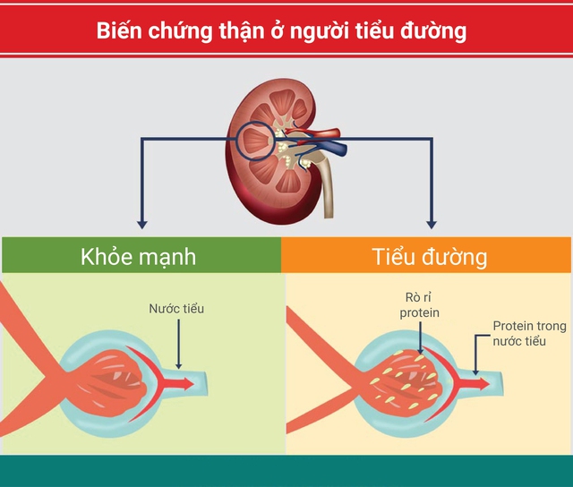 Phòng và điều trị suy thận do đái tháo đường- Ảnh 1.