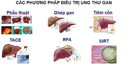 Ung thư gan có chữa khỏi được không?- Ảnh 1.