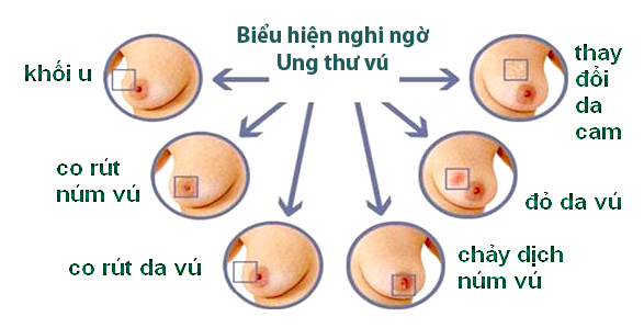 Xuất hiện khối ở vú có ý nghĩa gì ? Yếu tố nguy cơ gây Ung thư?