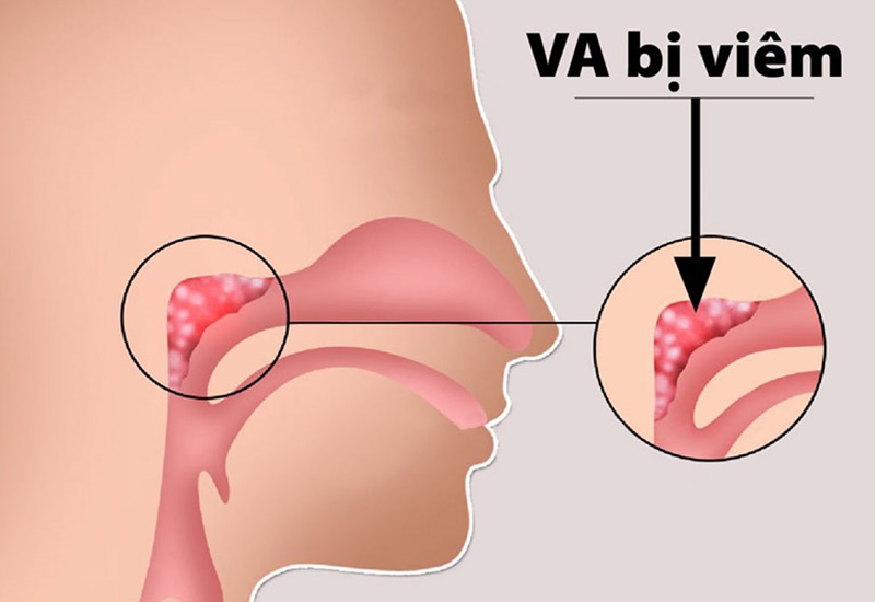 VA bị viêm