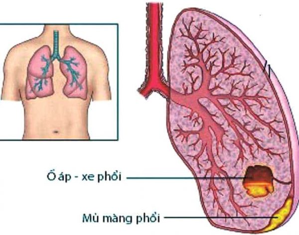 ap-xe-phoi-o-tre-em-600x472